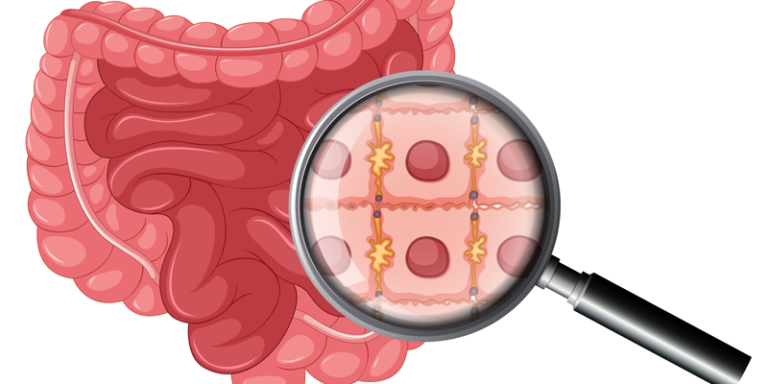Câncer Colorretal. A Ilustração é de um intestino com uma lupa afrente, focando em células intestinais